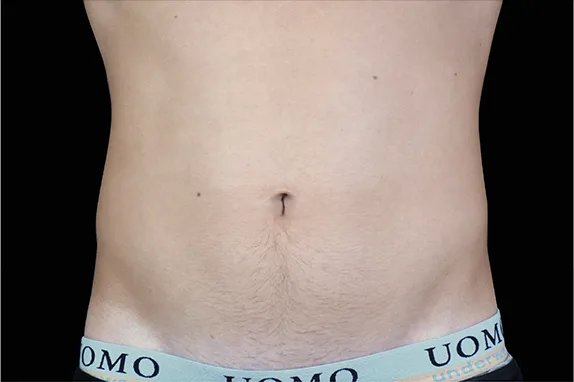 Emsculpt NEO, abdomen, after