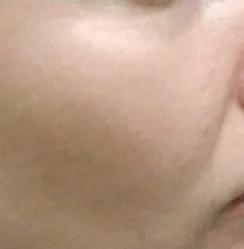 Photodynamic therapy, sun damage, after