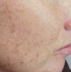 Photodynamic therapy, sun damage, before