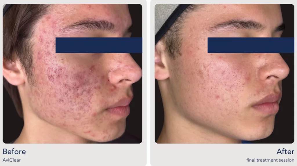 Acne Treatment That Works with AviClear at The Dermatology, Laser & Vein Center in Cincinnati