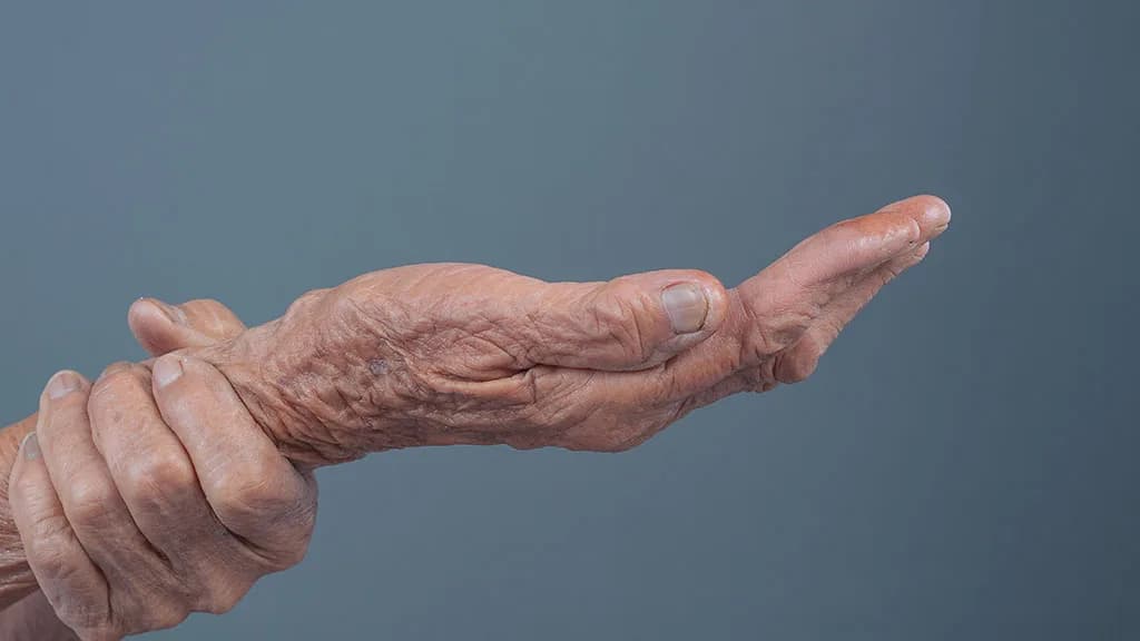 Are Hand and Arm Veins Treatable with Sclerotherapy? at The Dermatology, Laser & Vein Center in Cincinnati
