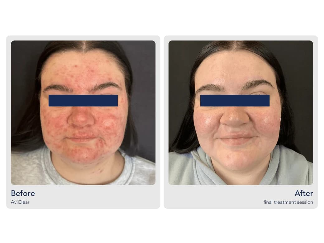 AviClear before and after photos of a teen patient with severe acne, labeled Before and After the final treatment session