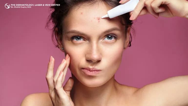 Benefits of Laser Acne Treatment in Cincinnati, Ohio at The Dermatology, Laser & Vein Center in Cincinnati