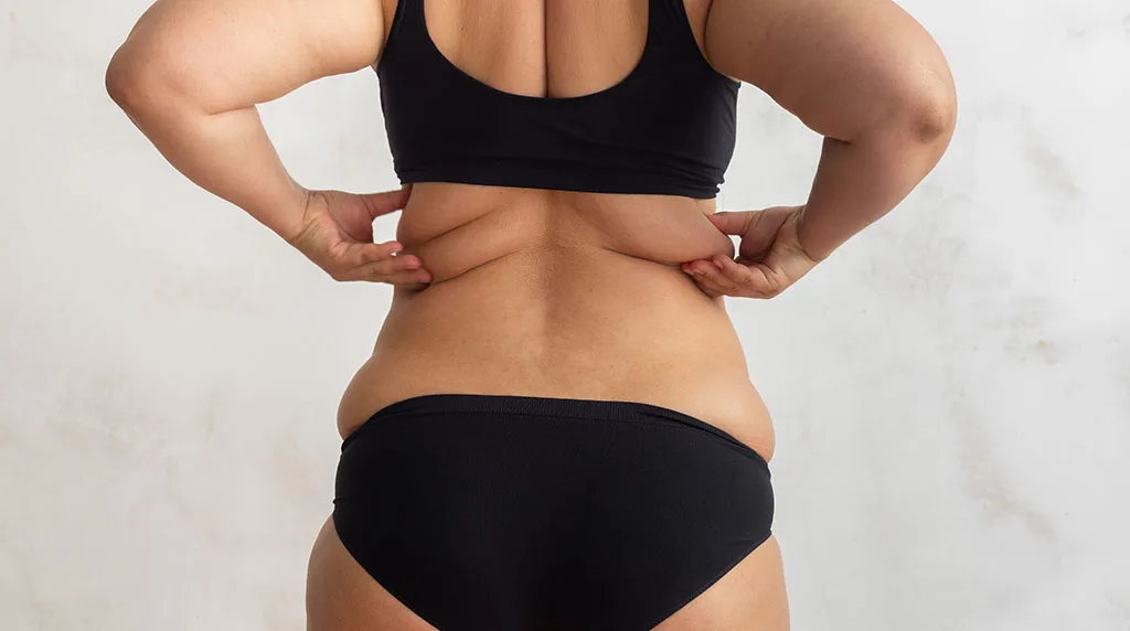 Best Bra Fat Reduction Treatment Without Surgery at The Dermatology, Laser & Vein Center in Cincinnati