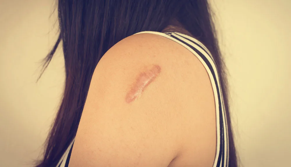 Best Laser Skin Resurfacing for Scar Revision at The Dermatology, Laser & Vein Center in Cincinnati