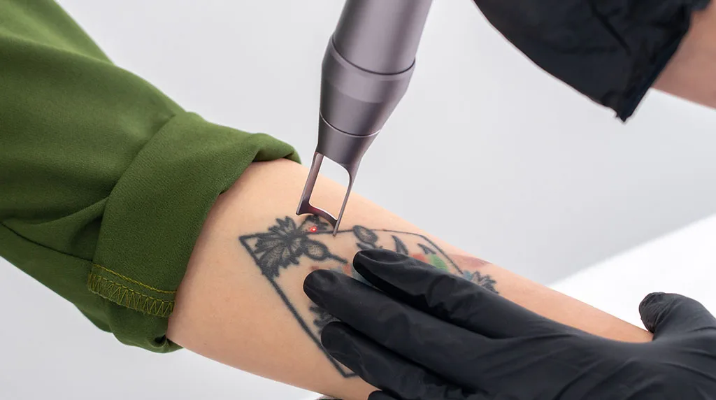 Best Laser Tattoo Removal Clinic in Cincinnati – Safe, Effective Ink Removal at The Dermatology, Laser & Vein Center in Cincinnati