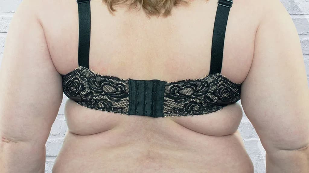 Can CoolSculpting Elite Treat Back Fat and Bra Bulge? at The Dermatology, Laser & Vein Center in Cincinnati