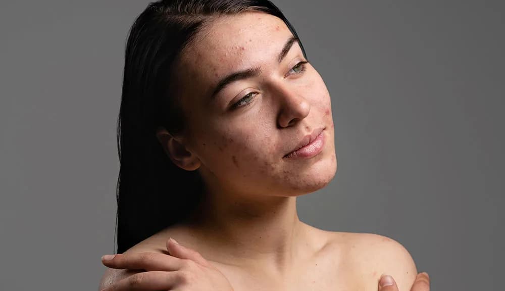 Can Fillers Be Used to Fix Acne Scars? at The Dermatology, Laser & Vein Center in Cincinnati