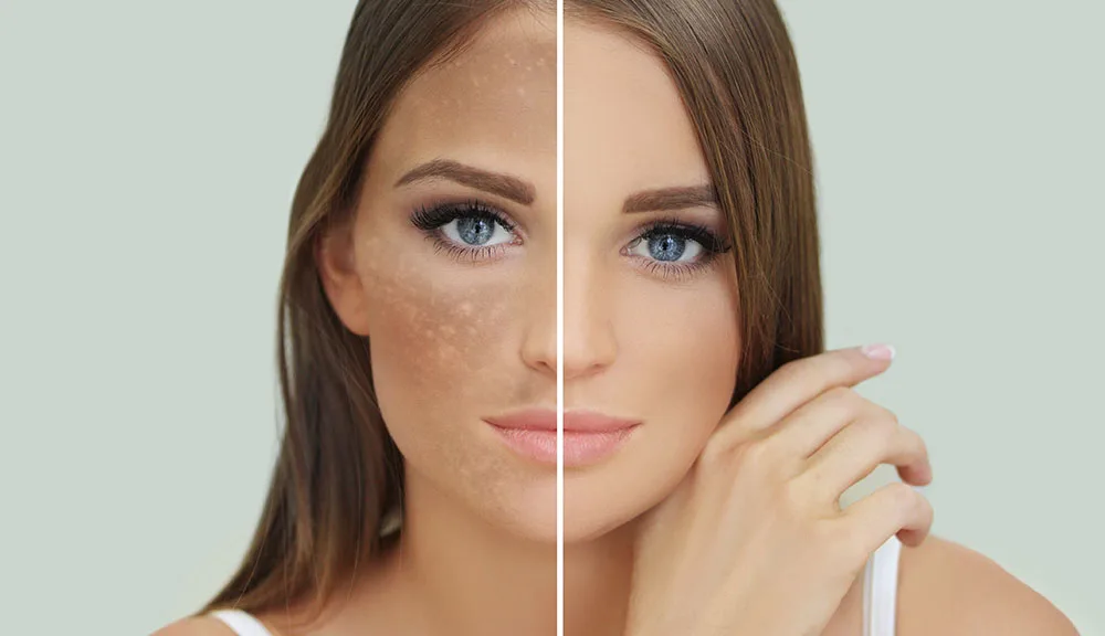 Can Hyperpigmentation Be Removed by Laser? at The Dermatology, Laser & Vein Center in Cincinnati