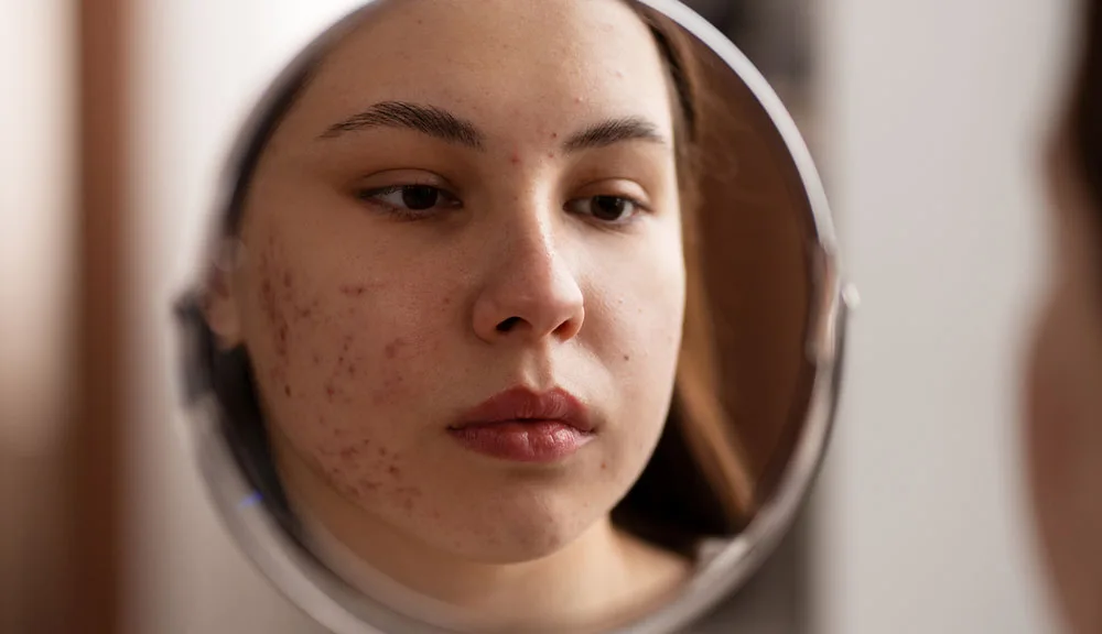 Can Laser Skin Resurfacing Treat Acne? at The Dermatology, Laser & Vein Center in Cincinnati