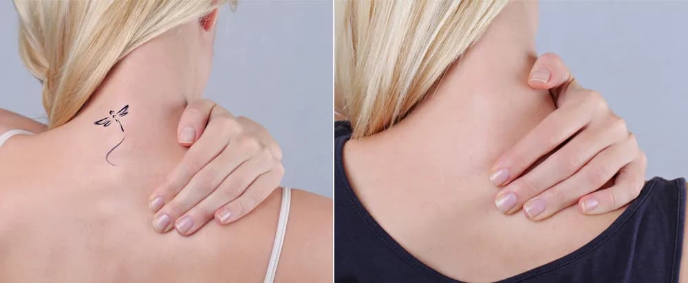 Can Laser Tattoo Removal Erase Any Tattoo? at The Dermatology, Laser & Vein Center in Cincinnati