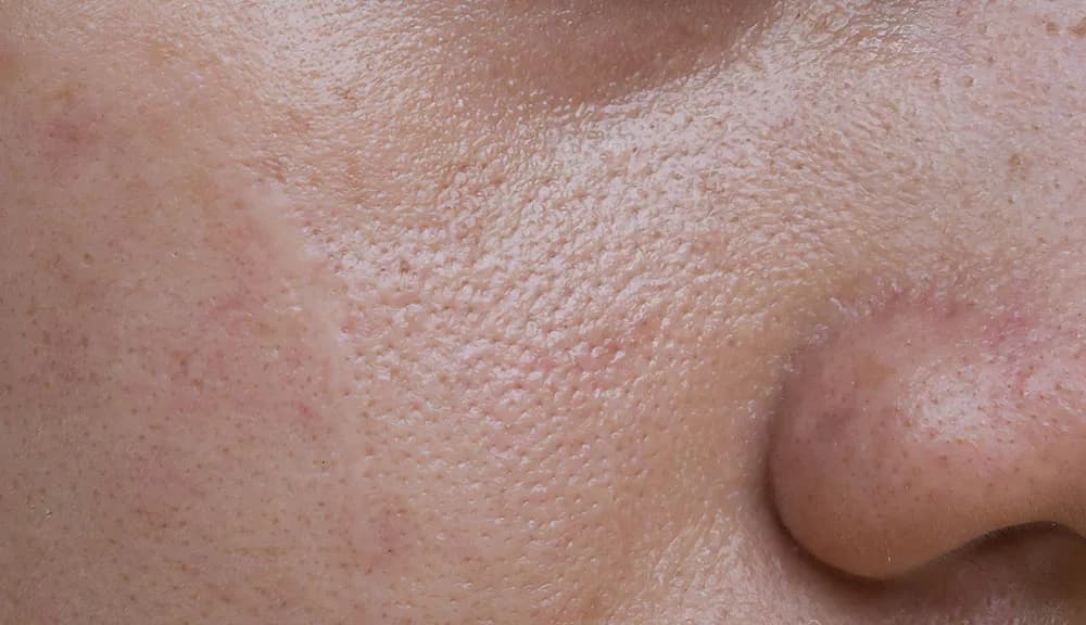 Can Laser Treatment Fix Large Pores? at The Dermatology, Laser & Vein Center in Cincinnati