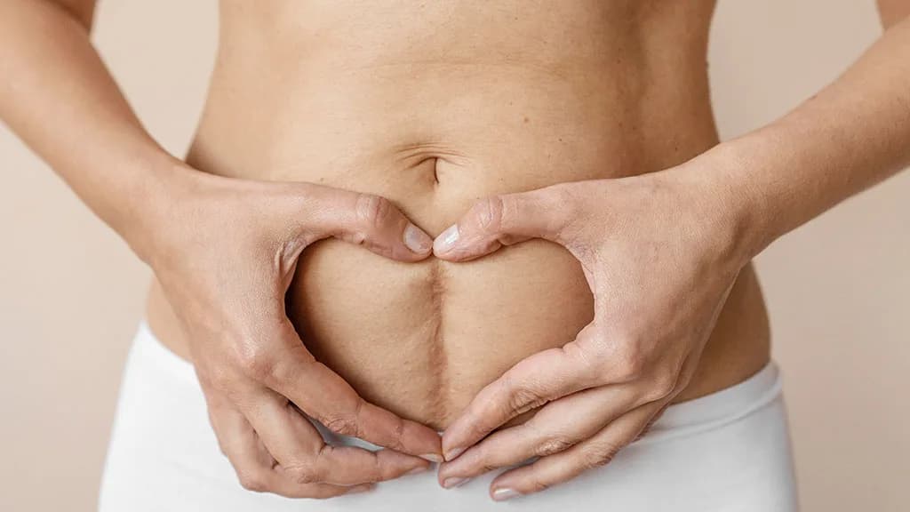Can VelaShape Help Tighten Loose Skin on the Abdomen? at The Dermatology, Laser & Vein Center in Cincinnati