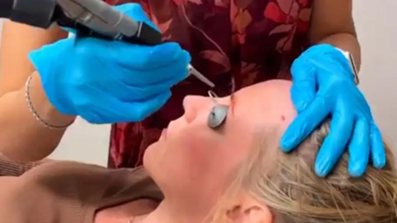 Cherry Angioma Removal with Laser: Treatment Video at The Dermatology, Laser & Vein Center in Cincinnati