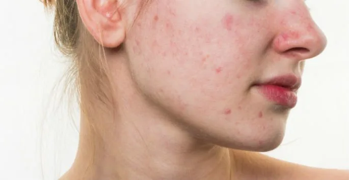 Common Causes of Acne at The Dermatology, Laser & Vein Center in Cincinnati