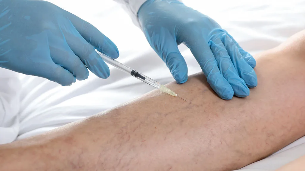Does Sclerotherapy Hurt? What the Treatment Feels Like at The Dermatology, Laser & Vein Center in Cincinnati