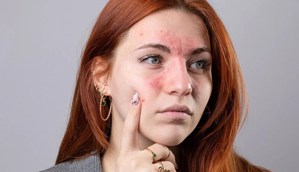 Managing Rosacea: Effective Treatments to Reduce Redness at The Dermatology, Laser & Vein Center in Cincinnati