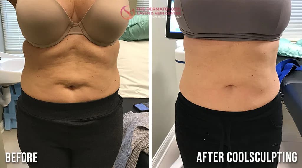 Fat Removal with CoolSculpting in Cincinnati, Ohio at The Dermatology, Laser & Vein Center in Cincinnati
