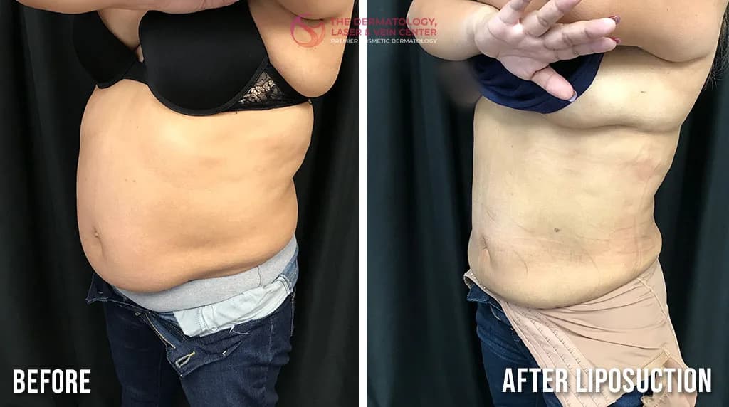 Fat Removal with Liposuction | Fat Removal Near Me in Cincinnati, Ohio at The Dermatology, Laser & Vein Center in Cincinnati