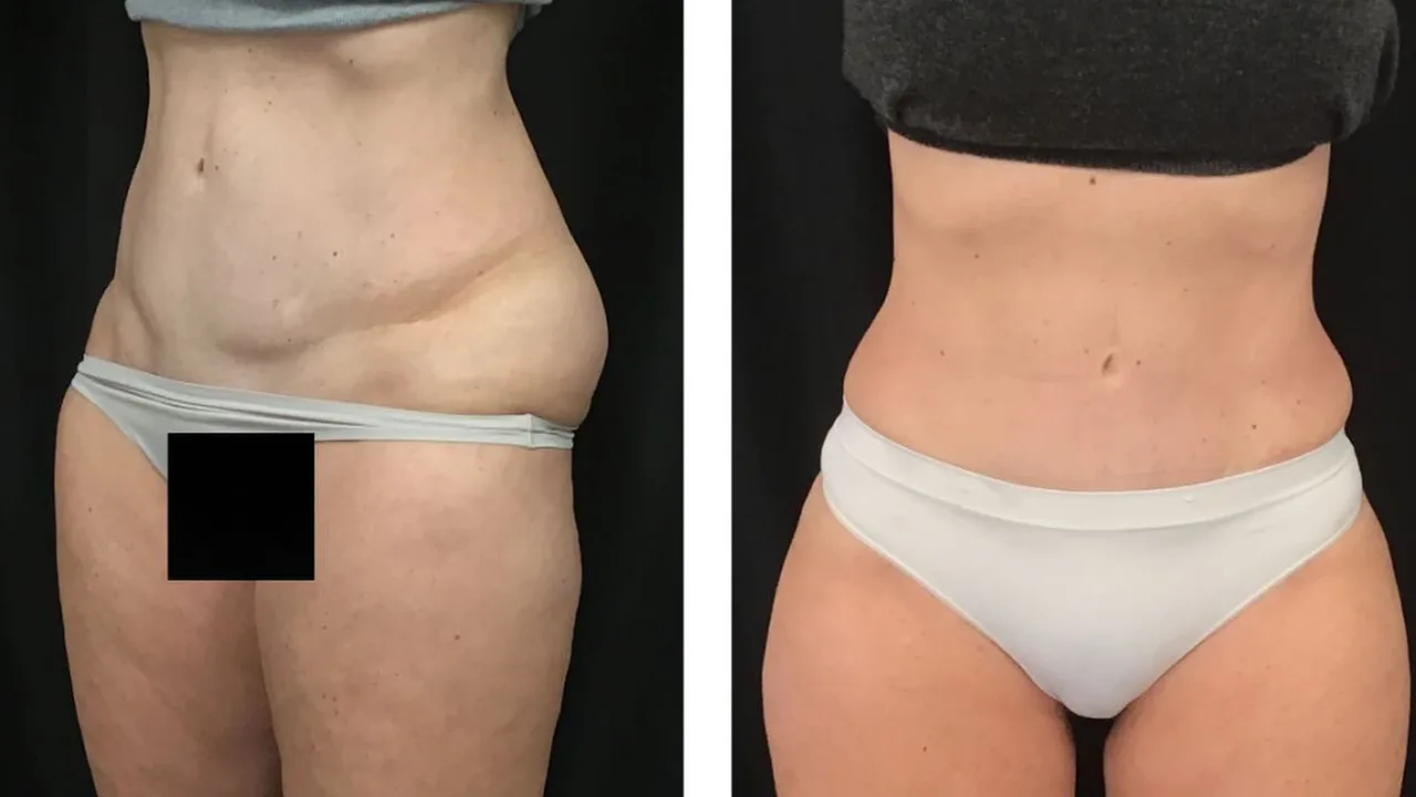 From Week One to Wow: What to Expect After VASER Liposuction at The Dermatology, Laser & Vein Center in Cincinnati