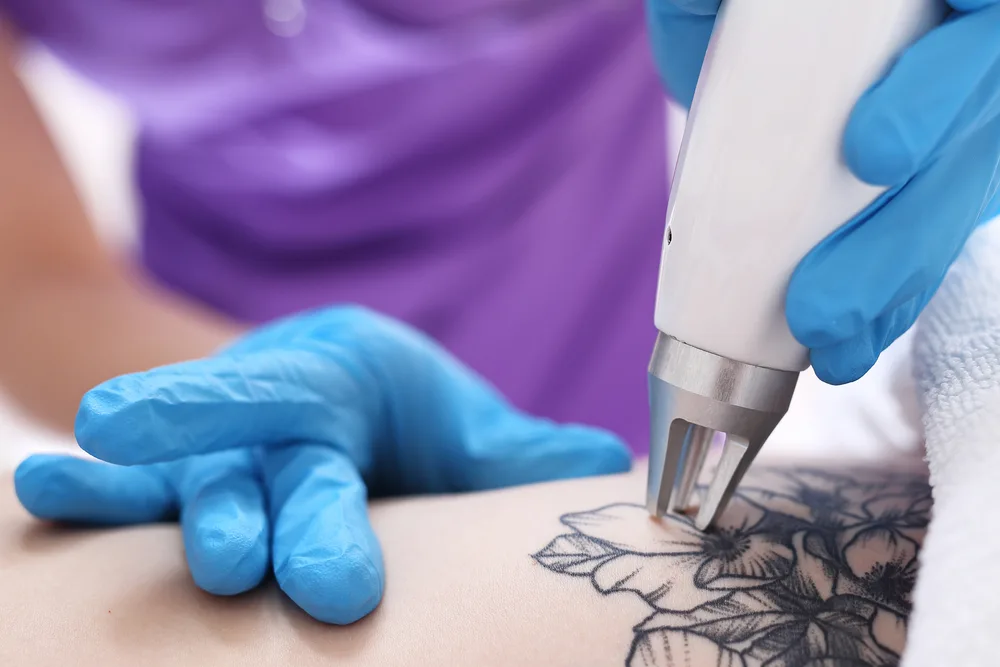 How Long Does Tattoo Removal Take? at The Dermatology, Laser & Vein Center in Cincinnati