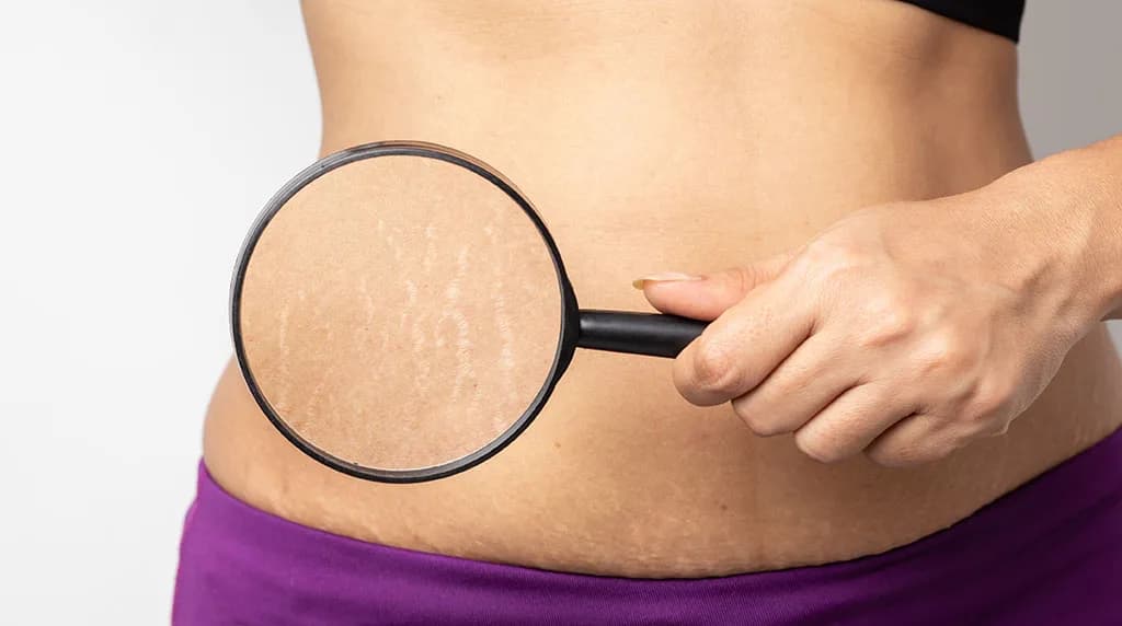 How Painful is Stretch Mark Removal? at The Dermatology, Laser & Vein Center in Cincinnati