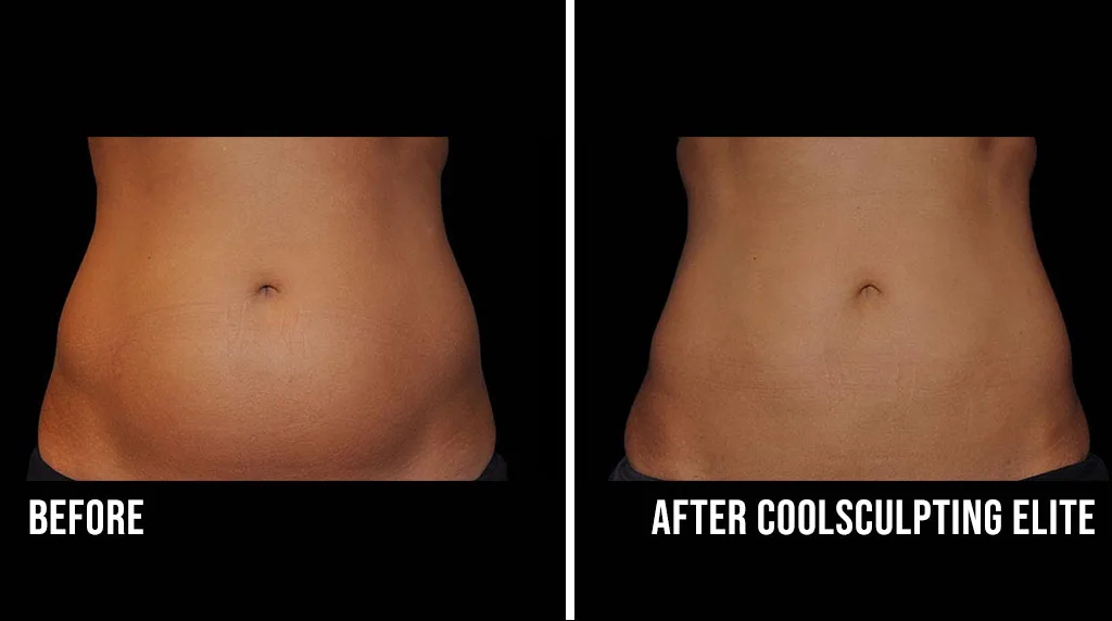 How to Get Rid of Stomach Fat | CoolSculpting Elite Treatment at The Dermatology, Laser & Vein Center in Cincinnati