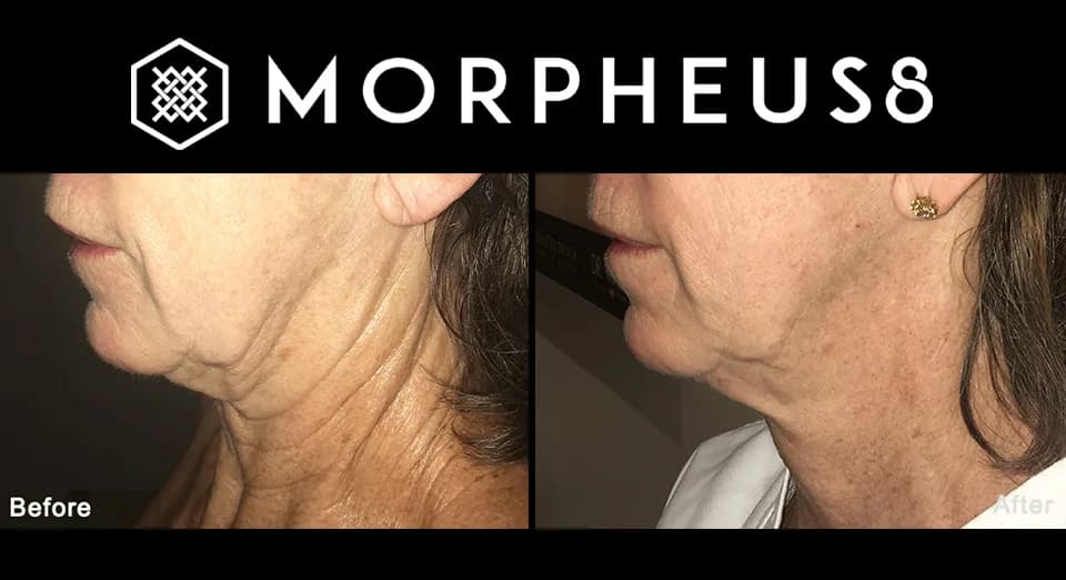How to Tighten Skin with Morpheus8 in Cincinnati, Ohio at The Dermatology, Laser & Vein Center in Cincinnati