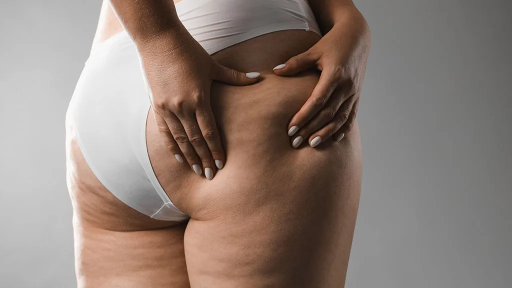 How to Treat Cellulite Without Surgery: The Ultimate Guide at The Dermatology, Laser & Vein Center in Cincinnati