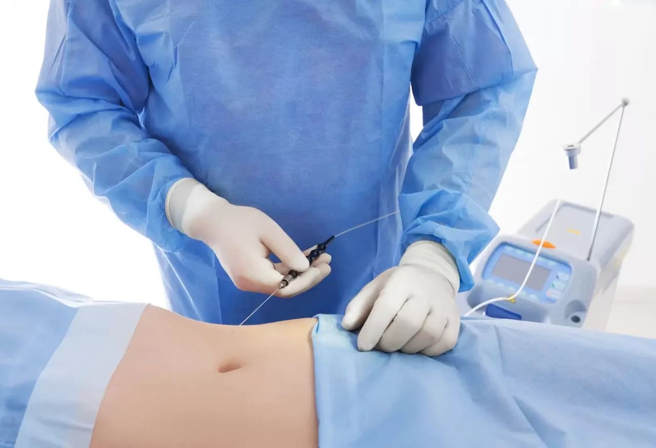 Is Smart Lipo the Same As Laser Lipo? at The Dermatology, Laser & Vein Center in Cincinnati