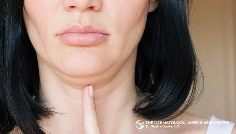 How to Treat the Double Chin with Injectable Kybella in Cincinnati, Ohio at The Dermatology, Laser & Vein Center in Cincinnati