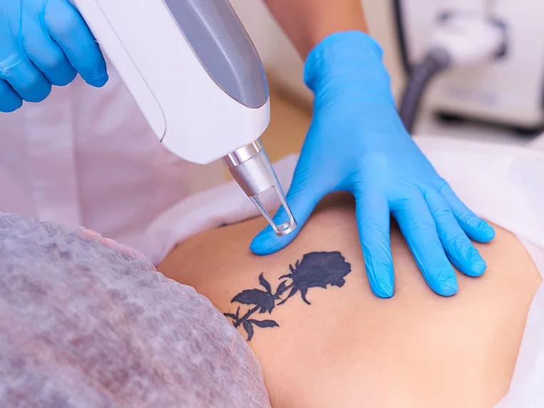 Clinician in blue gloves treating a black rose tattoo on a patient’s lower back with a laser handpiece