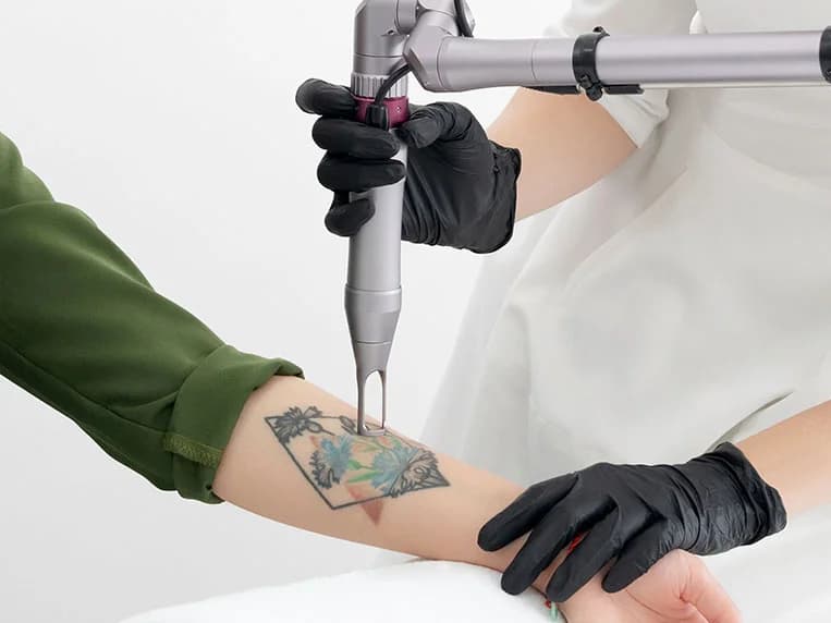 Clinician in black gloves using an articulated-arm laser on a colorful forearm tattoo