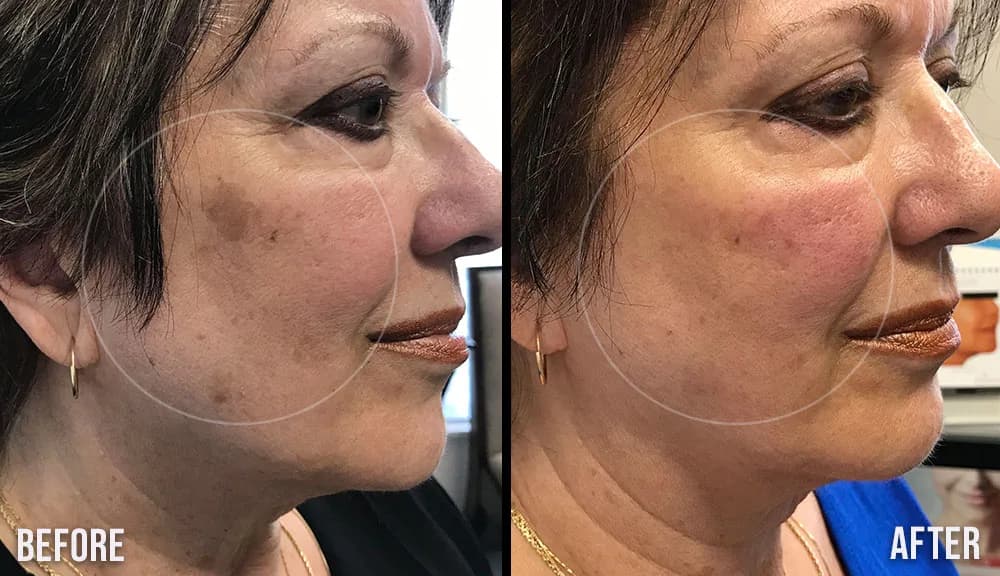 Most Effective Brown Spot Removal with BBL Laser Treatments in Cincinnati, Ohio at The Dermatology, Laser & Vein Center in Cincinnati
