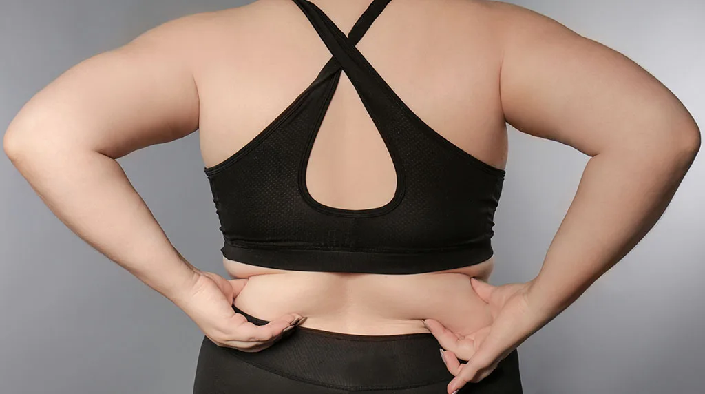 Permanent Bra Fat Reduction with VASER Lipo at The Dermatology, Laser & Vein Center in Cincinnati