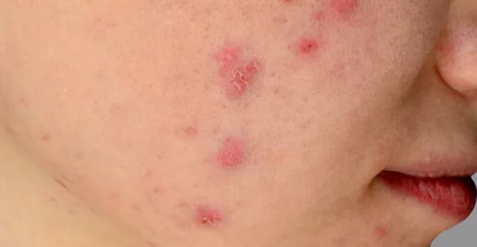 Reasons to Consider Acne Treatment at The Dermatology, Laser & Vein Center in Cincinnati