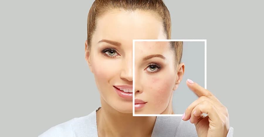 Reasons Why Early Acne Care Is Important at The Dermatology, Laser & Vein Center in Cincinnati