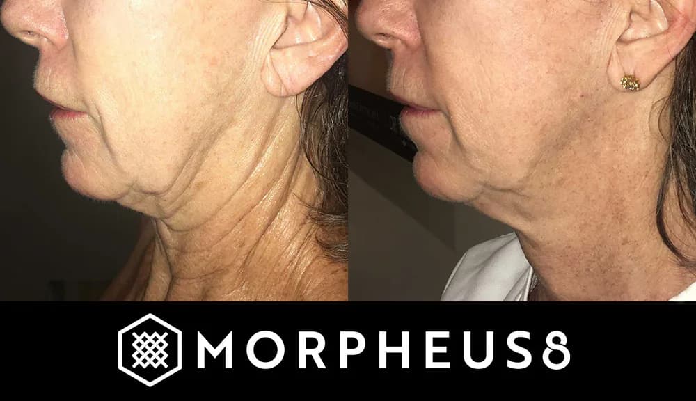 Resurface and Revitalize Your Skin with Morpheus8 in Cincinnati, Ohio at The Dermatology, Laser & Vein Center in Cincinnati