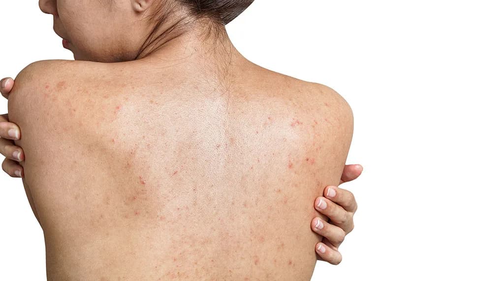 Say Goodbye to Bacne with AviClear at The Dermatology, Laser & Vein Center in Cincinnati