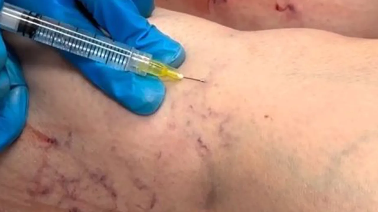 Sclerotherapy in Action: What It’s Really Like to Treat Spider and Varicose Veins at The Dermatology, Laser & Vein Center in Cincinnati