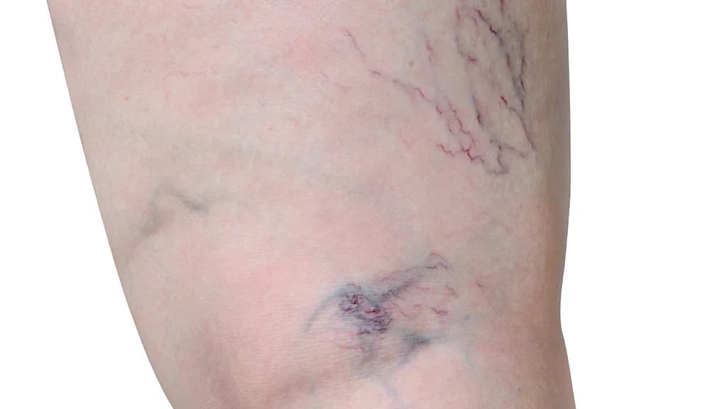 Sclerotherapy vs. Laser Vein Treatment: Which Is Better for Spider Veins? at The Dermatology, Laser & Vein Center in Cincinnati