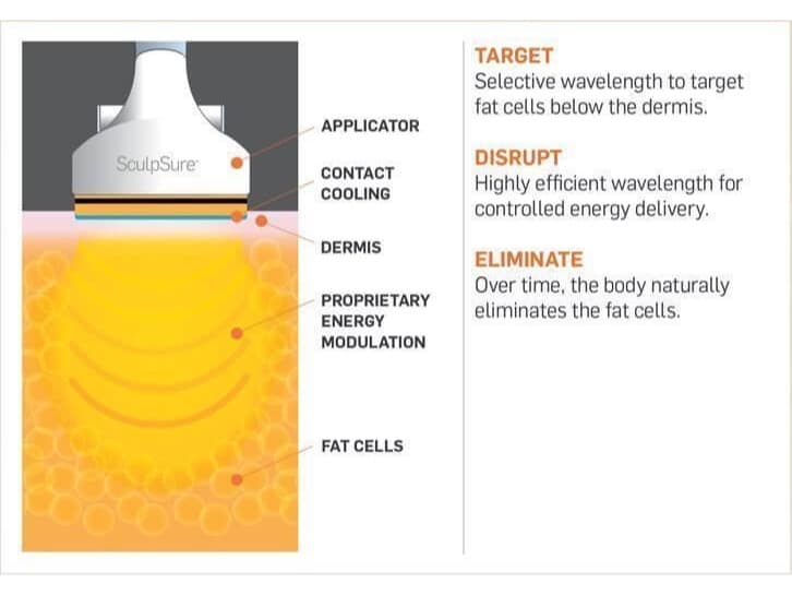SculpSure applicator diagram showing how laser energy targets, disrupts and eliminates fat cells