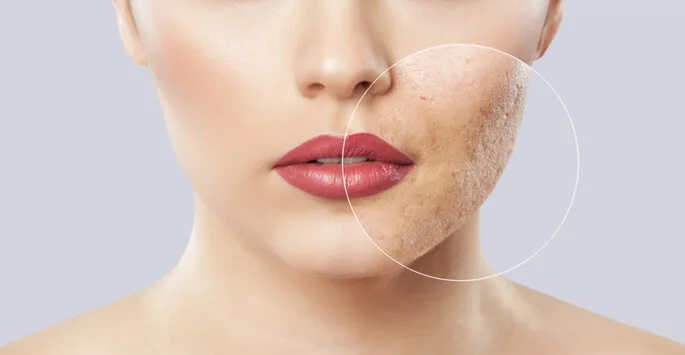Take the Next Step with Acne Scar Removal at The Dermatology, Laser & Vein Center in Cincinnati