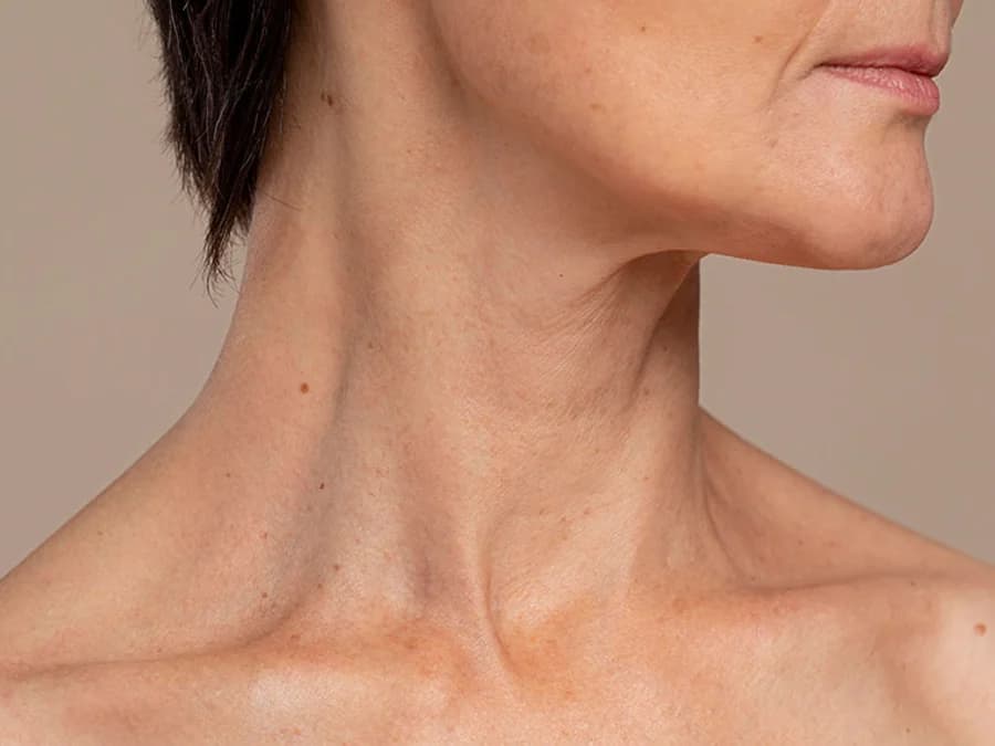 Profile view of a woman’s neck showing loose, crepey skin and horizontal neck lines