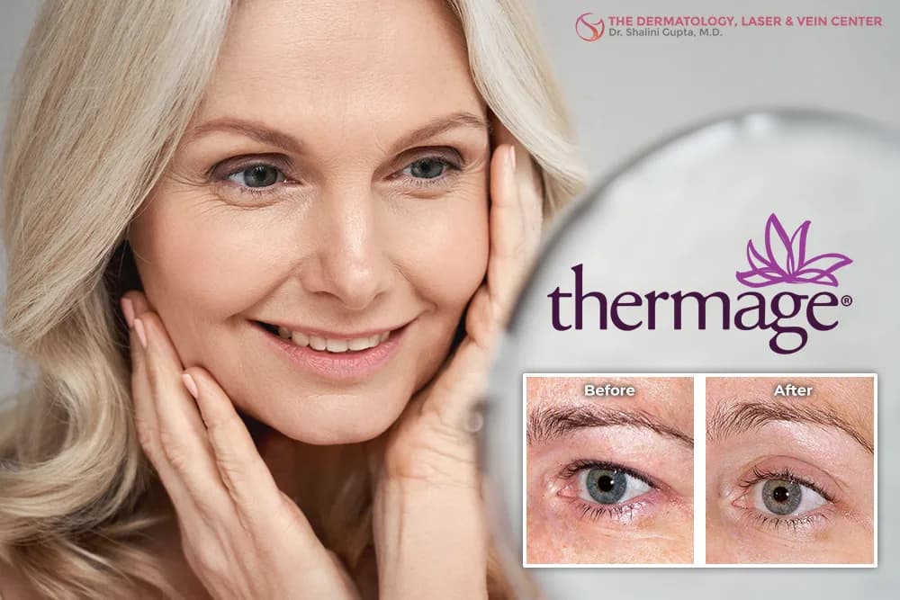 Thermage Skin Tightening for Aging & Sagging Eyes at The Dermatology, Laser & Vein Center in Cincinnati
