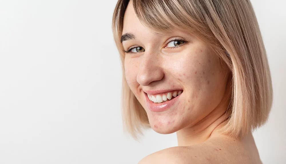 Transform Your Skin with Microneedling for Acne Scar Removal in Cincinnati, Ohio at The Dermatology, Laser & Vein Center in Cincinnati