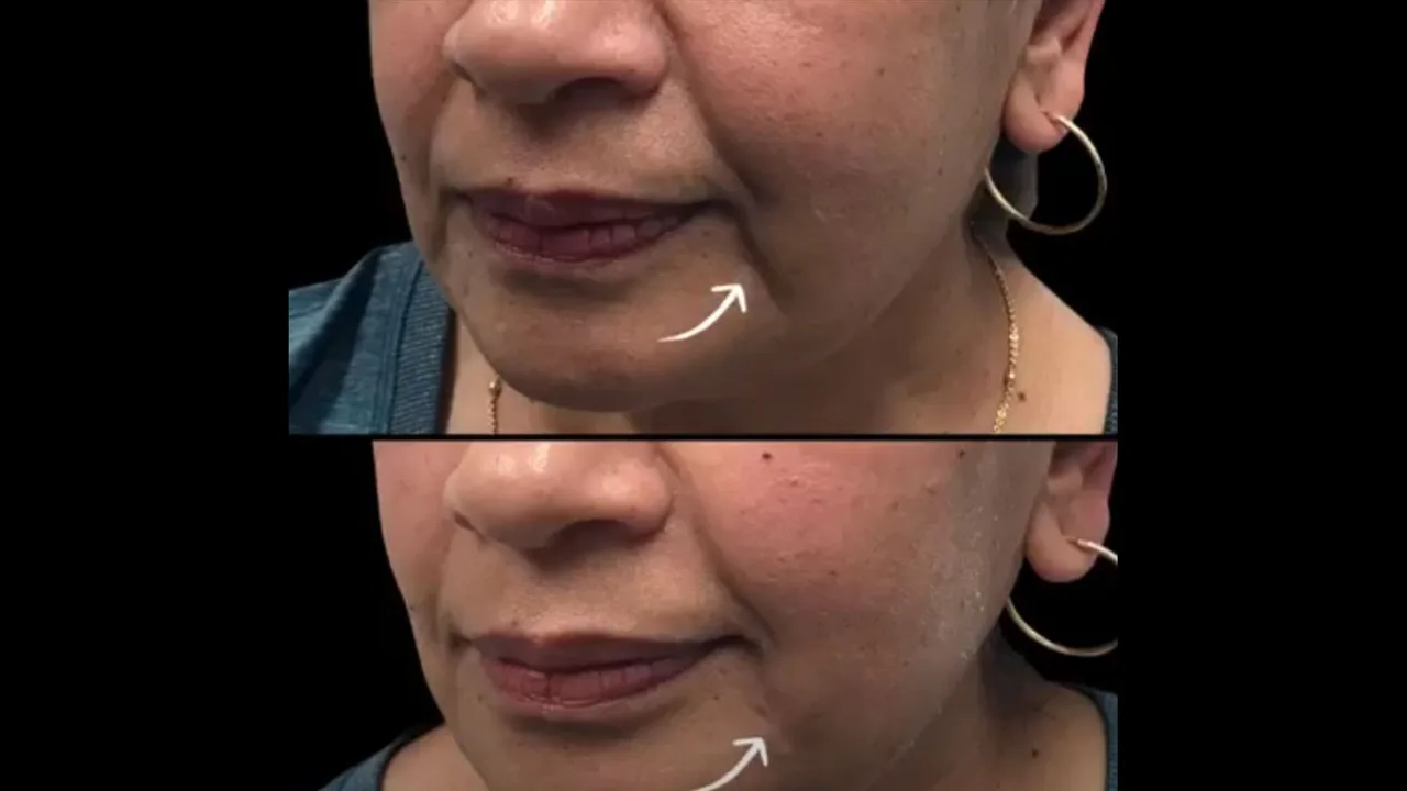 Ultherapy and Fillers: The Perfect Combination for Lifting, Smoothing, and Restoring Youthful Volume at The Dermatology, Laser & Vein Center in Cincinnati
