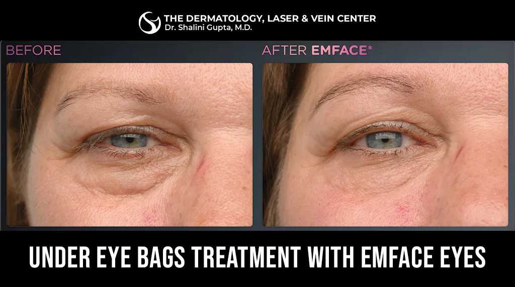Under Eye Bags Treatment Near Me – EMFACE Eyes at The Dermatology, Laser & Vein Center in Cincinnati