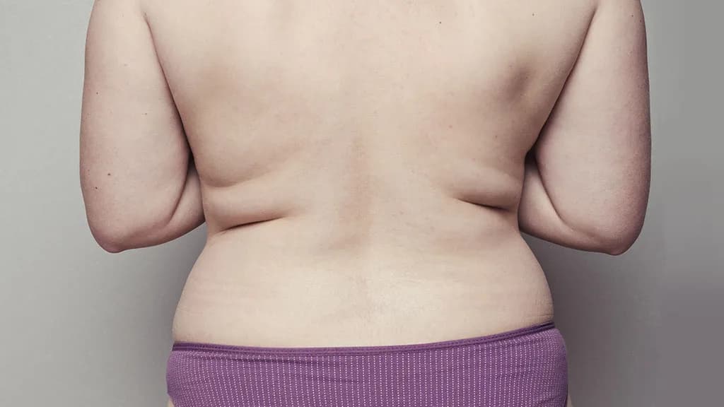 Vanquish for the Back: Eliminate Stubborn Bra Bulge Without Downtime at The Dermatology, Laser & Vein Center in Cincinnati