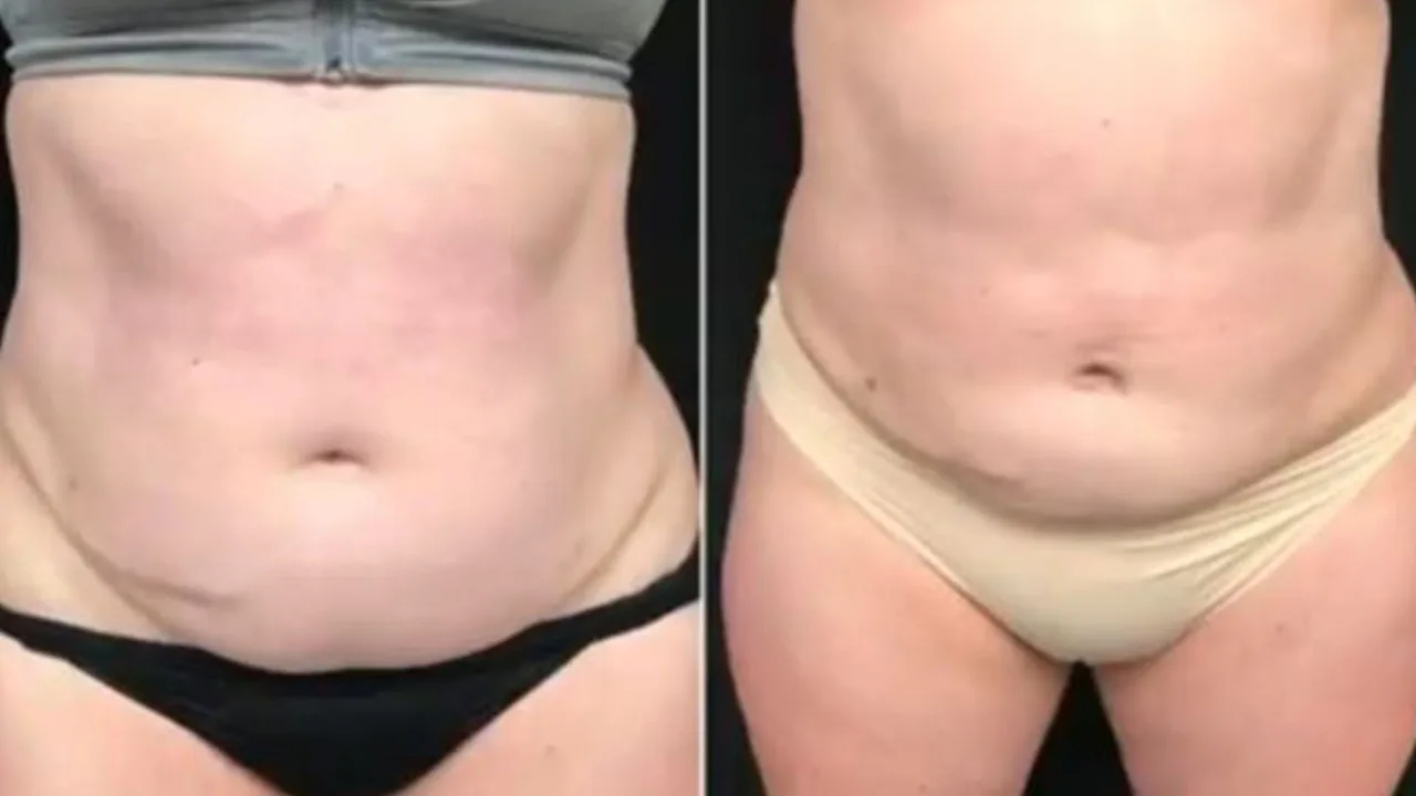 VASER Liposuction Results for Abdomen and Thighs at The Dermatology, Laser & Vein Center in Cincinnati